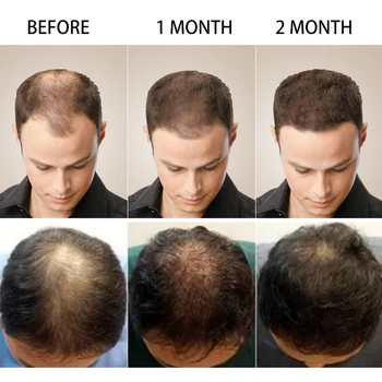PURC Greitą Plaukų Augimą Alyvos Esmė Sveikatos Plaukų Slinkimas Gydymo Plaukų Augimą Produktai, Plaukų Priežiūra 20ml
